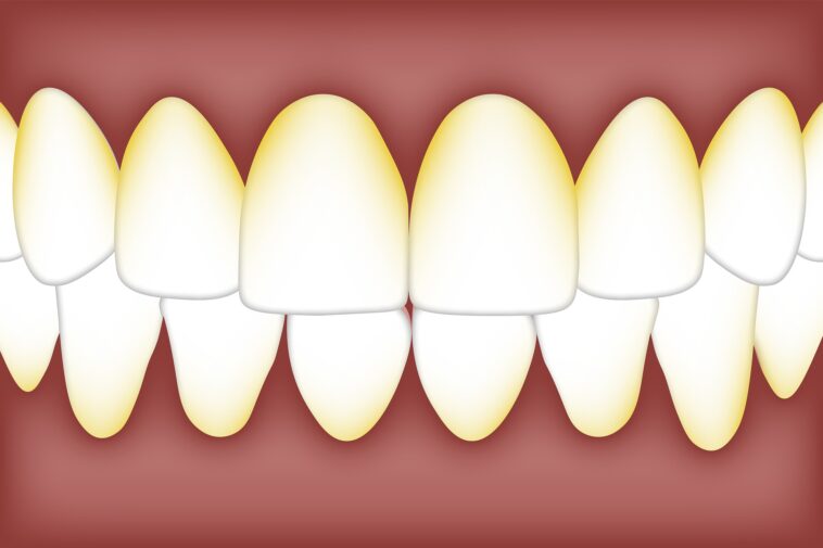 dentista placa dental